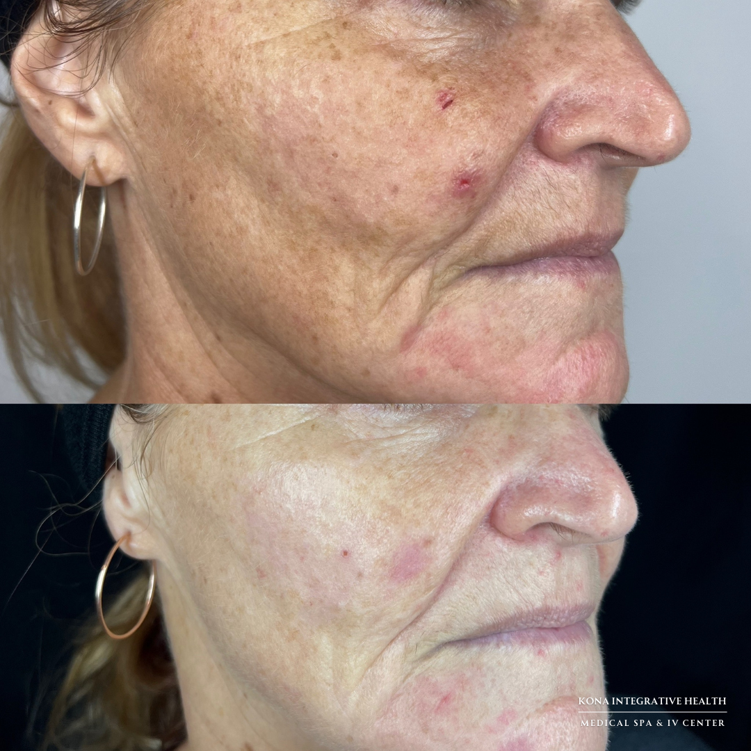 Picosure Pro Laser treatment Kailua-Kona, Hawaii