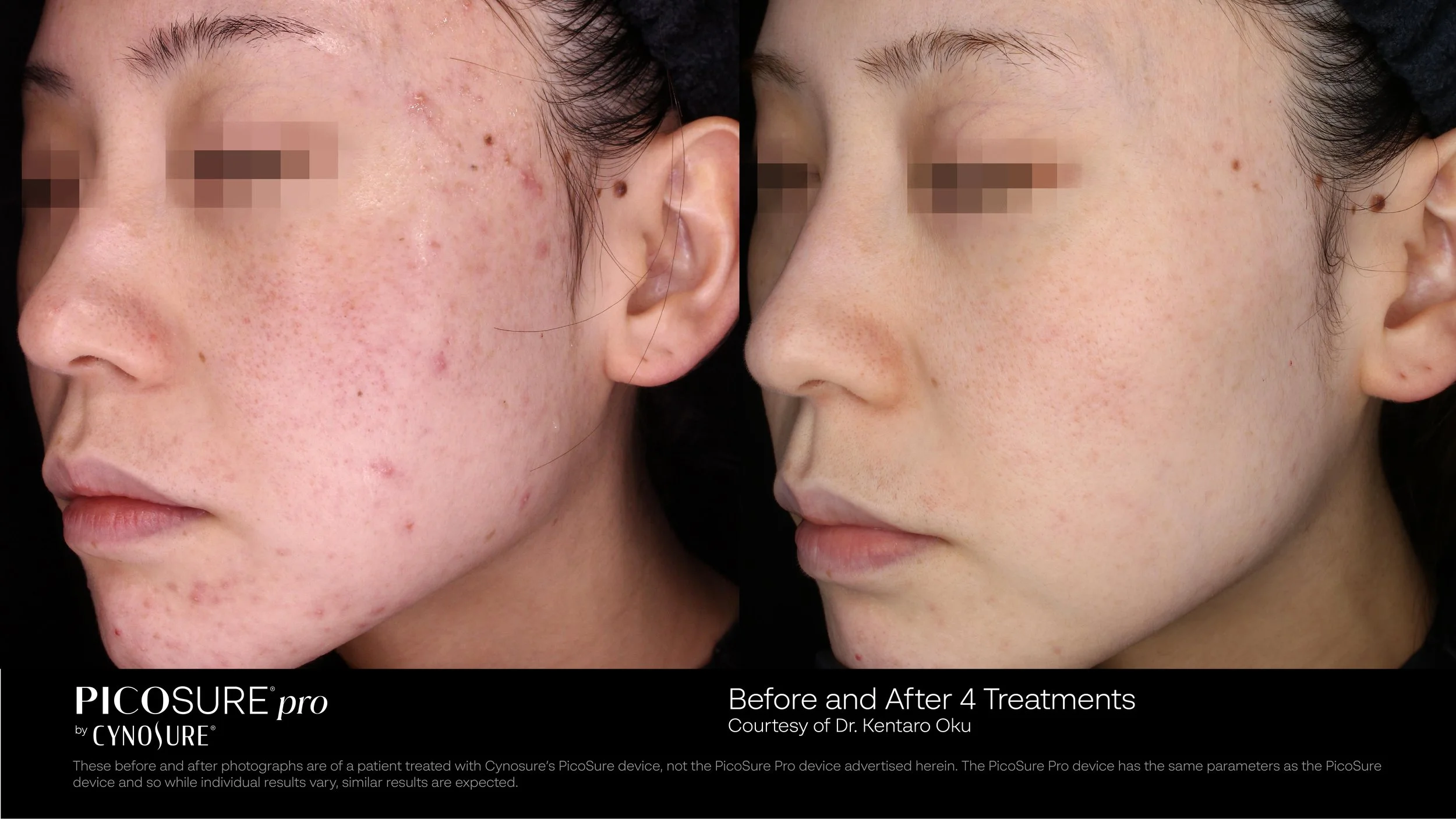 PRD_4669_PicoSurePro_Bam