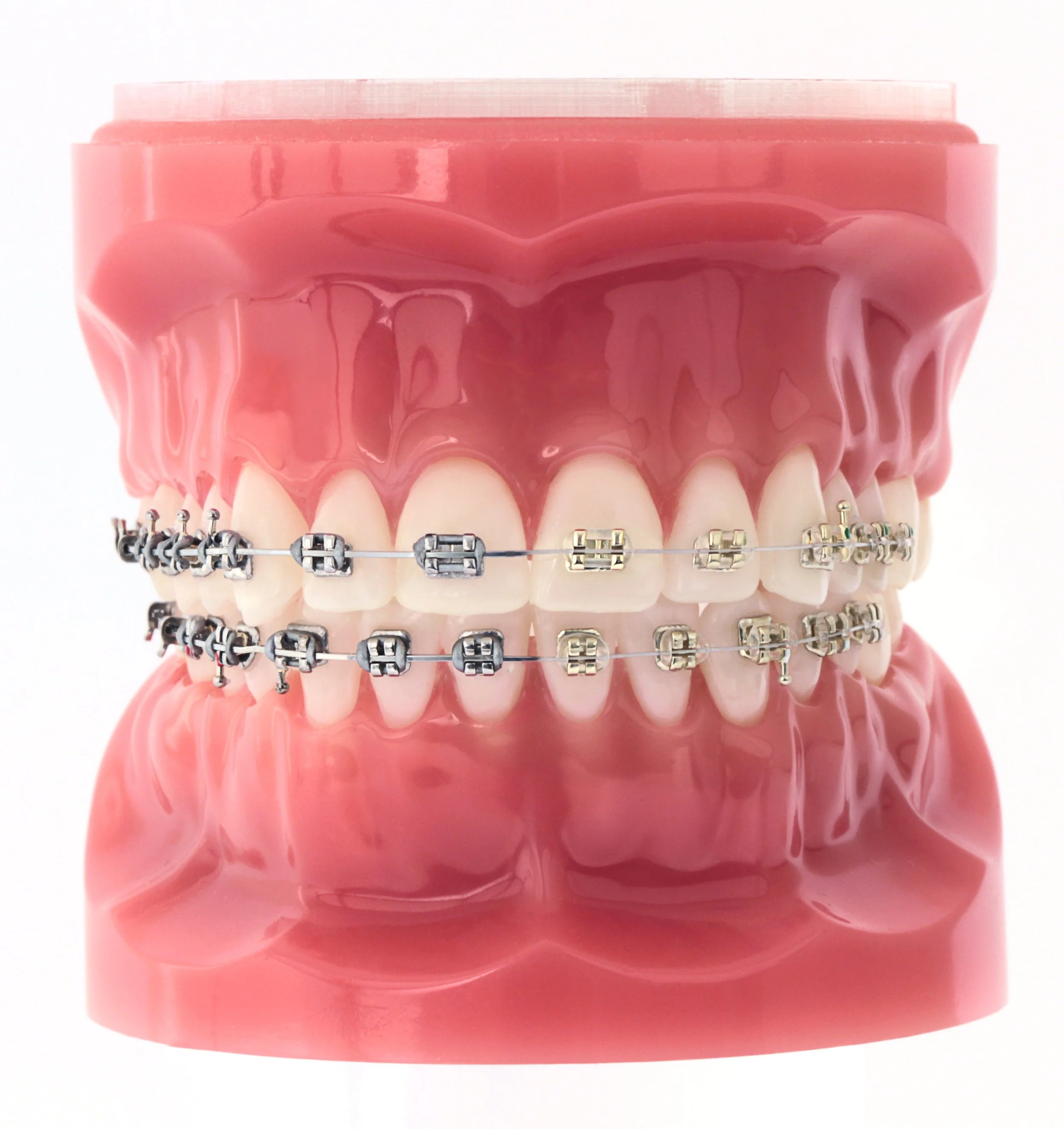 Tom Ethell champagne braces orthodontics canberra woden rose gold aesthetic brackets