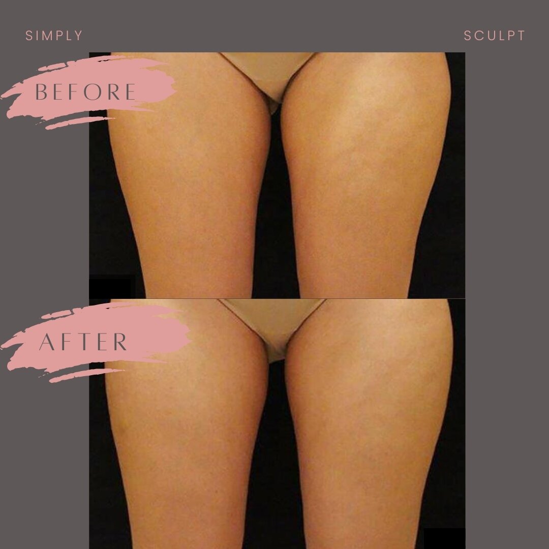 Drum roll 🥁 ⁠
⁠
Introducing... Leg-tastic Sculpting! 🦵🔥⁠
⁠
Tired of those stubborn thigh gaps and wobbly knees? Say goodbye to the struggle and hello to sleek, sculpted legs with our cutting-edge treatments! 🌟⁠
⁠
No downtime, no worries. Just smo