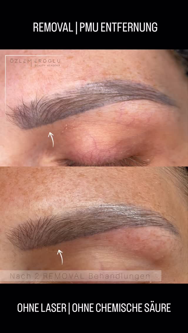 Sanfte PMU-Entfernung – Ohne Laser. Ohne Säure. Ohne Kompromisse. ✨
Du hast genug von alten, verblassten oder unsauber gestochenen Permanent Make-up Linien? Schluss mit unerwünschtem Look!
Unsere innovative PMU-Entfernungsmethode e