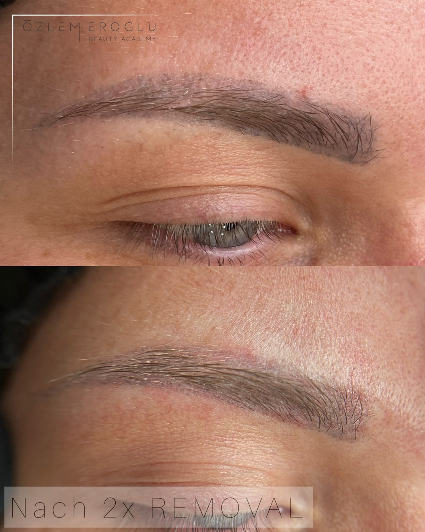 🔹 PMU REMOVAL – ENDLICH FREI VOM BLAUSTICH! 🔹
✨ Echte Ergebnisse nach nur 2 Behandlungen!
Diese liebe Kundin kam zu mir, nachdem sie bereits woanders versucht hatte, ihre missglückte Permanent Make-up Augenbraue entfernen zu lassen &nd