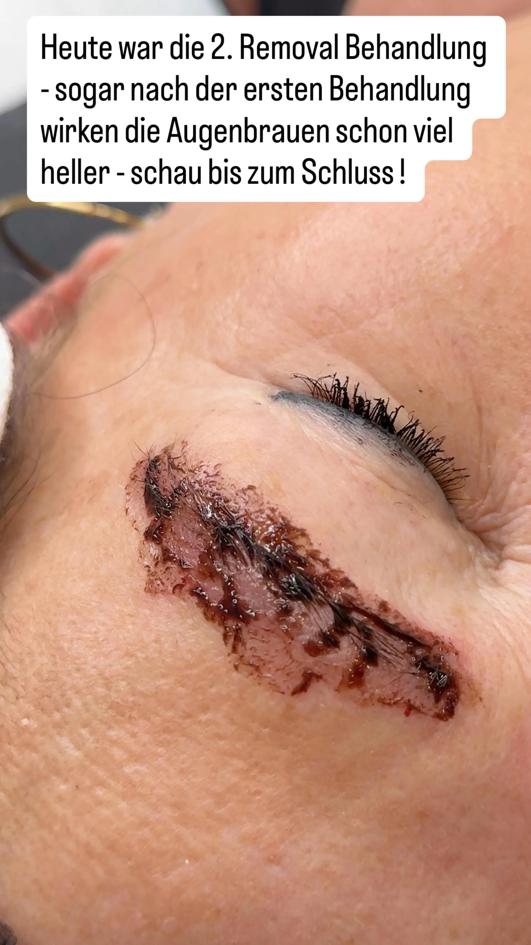 PMU Removal – sichtbare Veränderung schon nach der 1. Behandlung
Meine Kundin kam heute nach 6 Wochen zu ihrer 2. Removal-Behandlung 💫
Vorher hatte sie sehr rötliche Augenbrauen, die sie schon lange störten.
💡 Schon nach nur