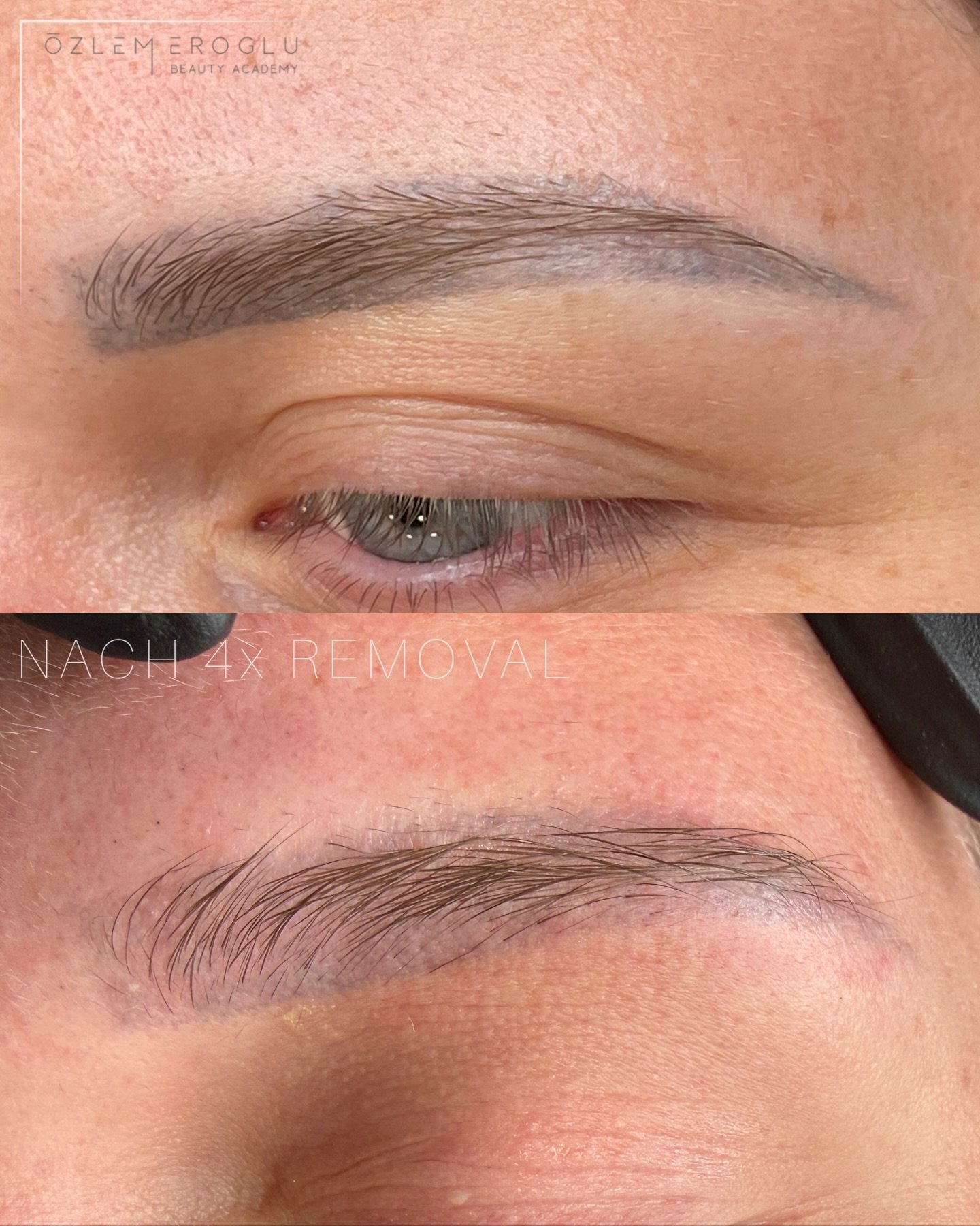 Dieses Removal-Ergebnis macht mich so stolz ✨

Nach 4 Behandlungen sieht man deutlich, wie hell die alten Augenbrauen geworden sind und wie wundersch&ouml;n die Haut abgeheilt ist &ndash; klar, ruhig und bereit f&uuml;r einen Neuanfang.

Meine Kundin