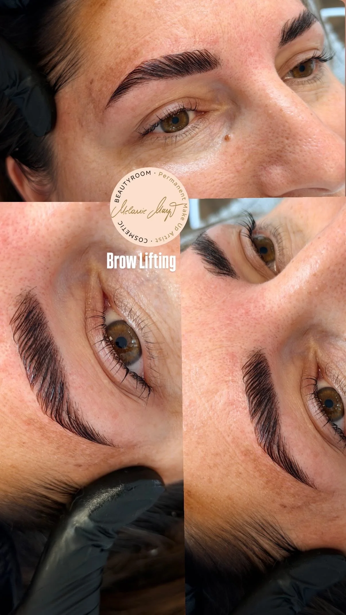 BROW Lifting