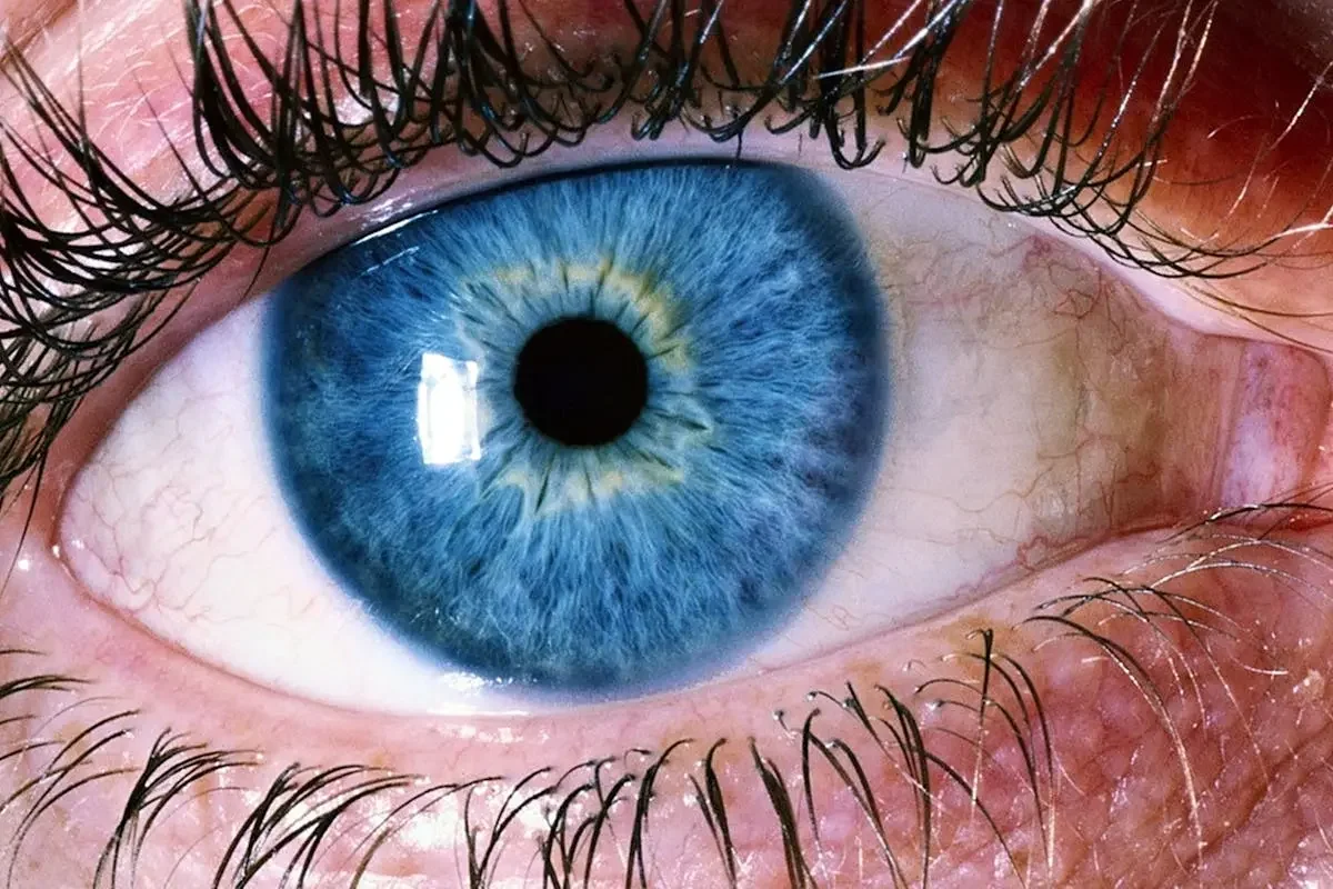 What Is Ocular Rosacea and How Can It Affect Vision & Eye Comfort?