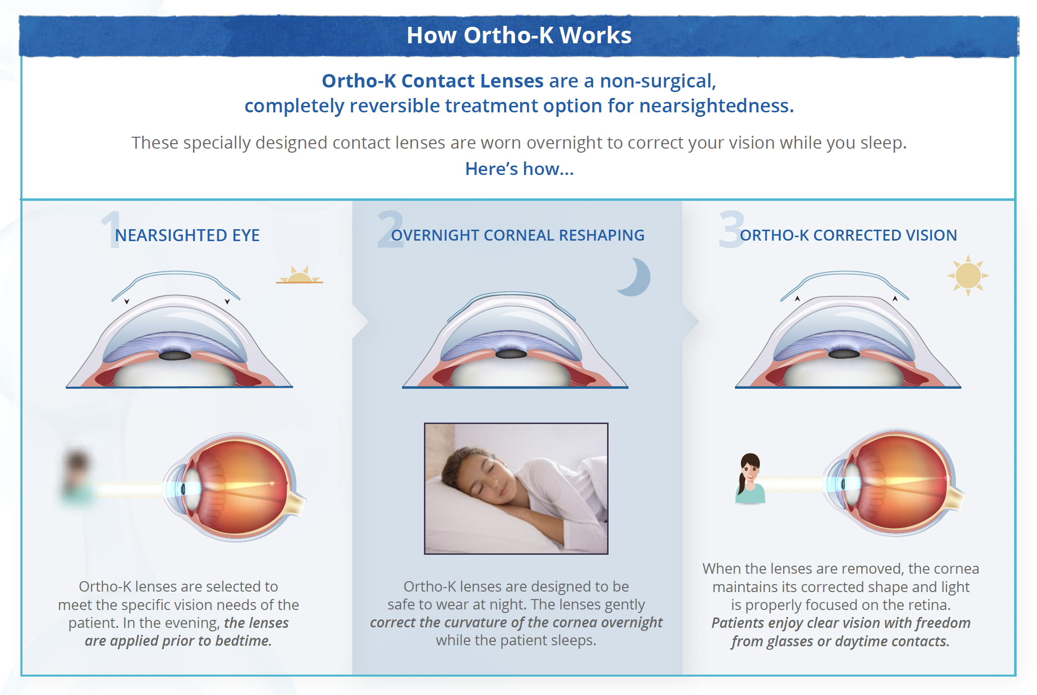 Orthokeratology Discover Clear Vision Today Innovative EyeCare Orthokeratology Discover Clear Vision Today Innovative EyeCare