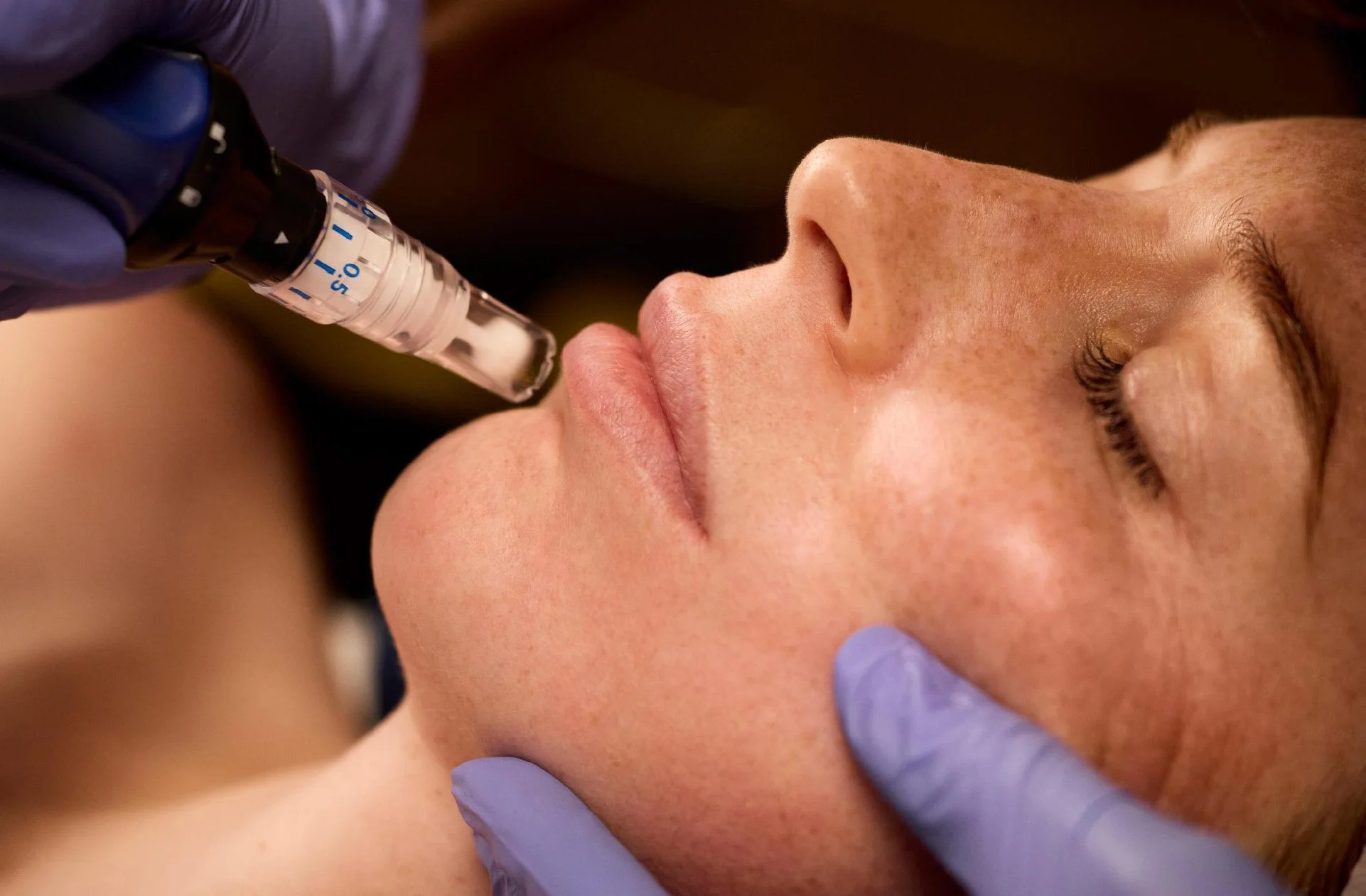 A woman receiving a facial injection, lying down with eyes closed, with medical gloves on the practitioner holding a syringe close to her face.