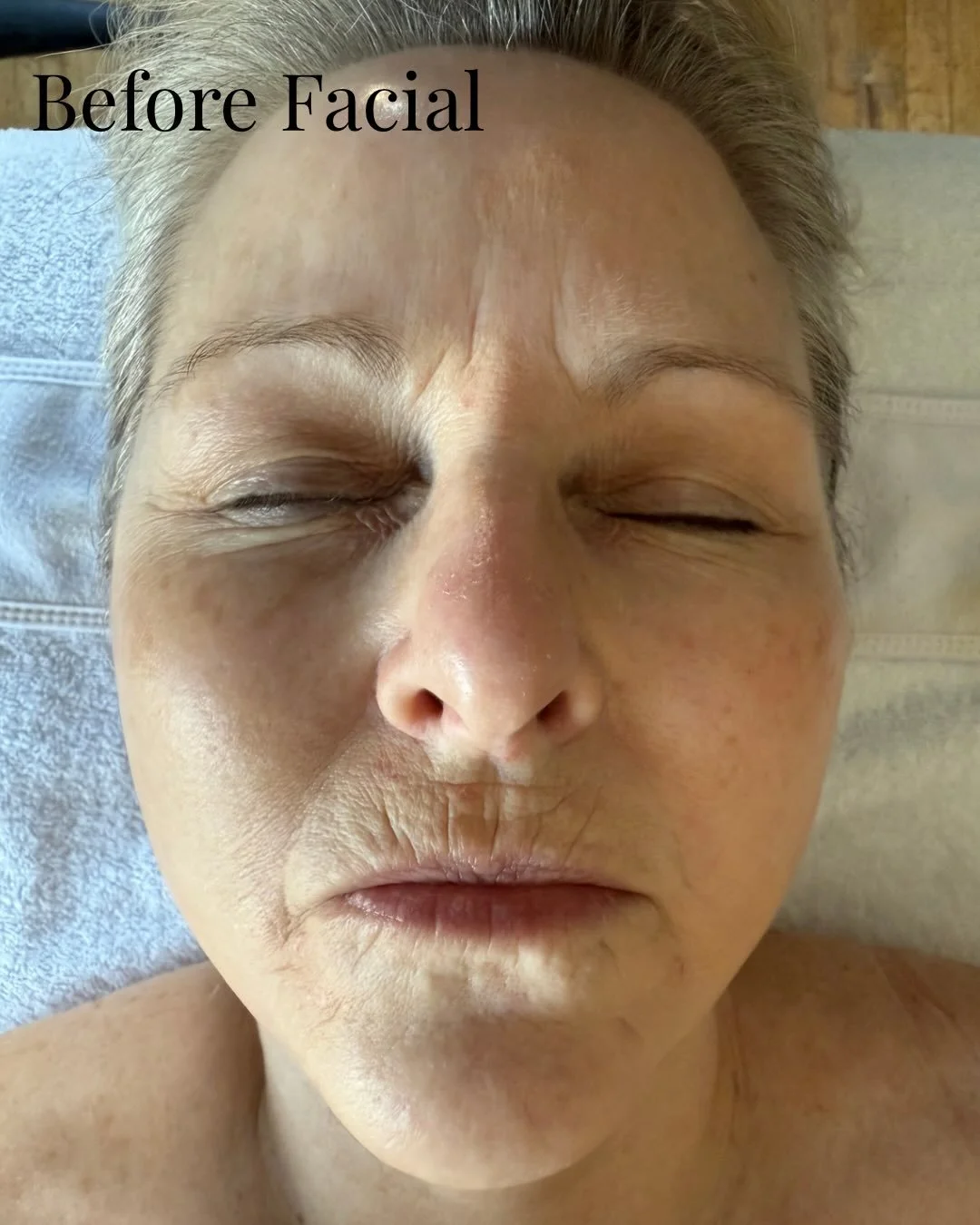 Before &amp; After 🪷 Revealing brighter, smoother, deeply hydrated skin with visible facial results after just one treatment. Our facials help improve skin texture, hydration, fine lines, and restores a healthy glow for refreshed, radiant skin 🌟 ca
