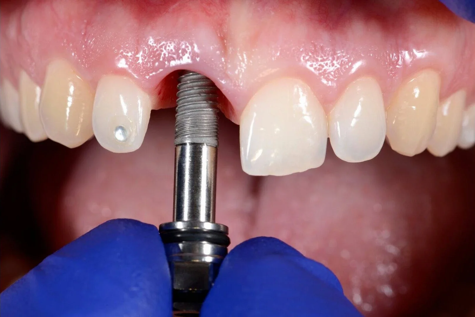 Implantes dentales: Guía completa