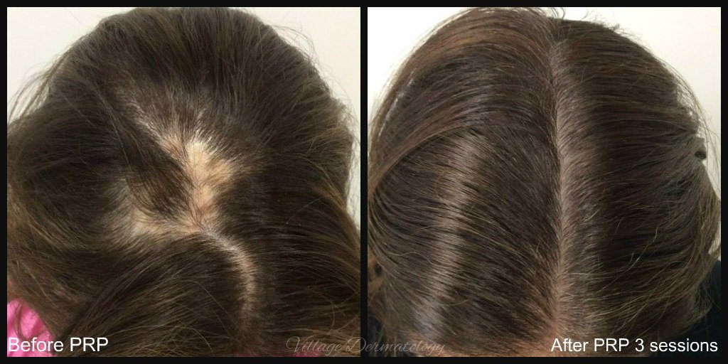 PRP+for+alopecia+areata+B+and+A.jpg