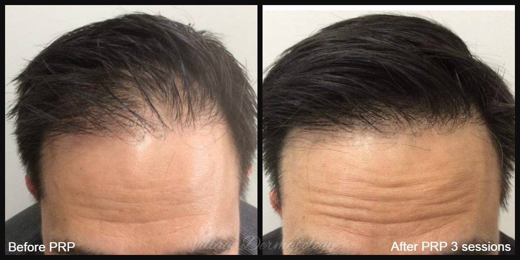 500 первые результаты. Мезотерапия для волос от выпадения у мужчин.