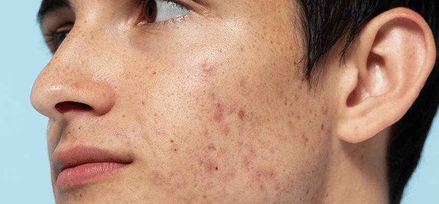 Case Report: Treating Moderate Inflammatory Acne in a Teen Male