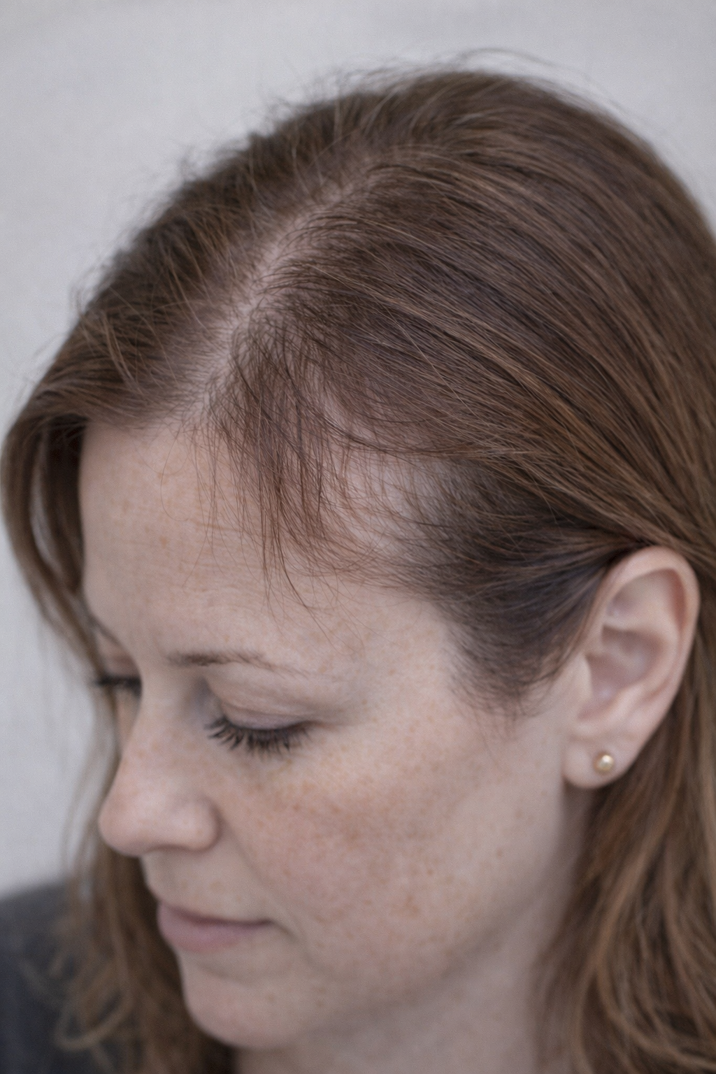 “Is My Hormone Therapy Causing My Hair to Thin at the Temples?”