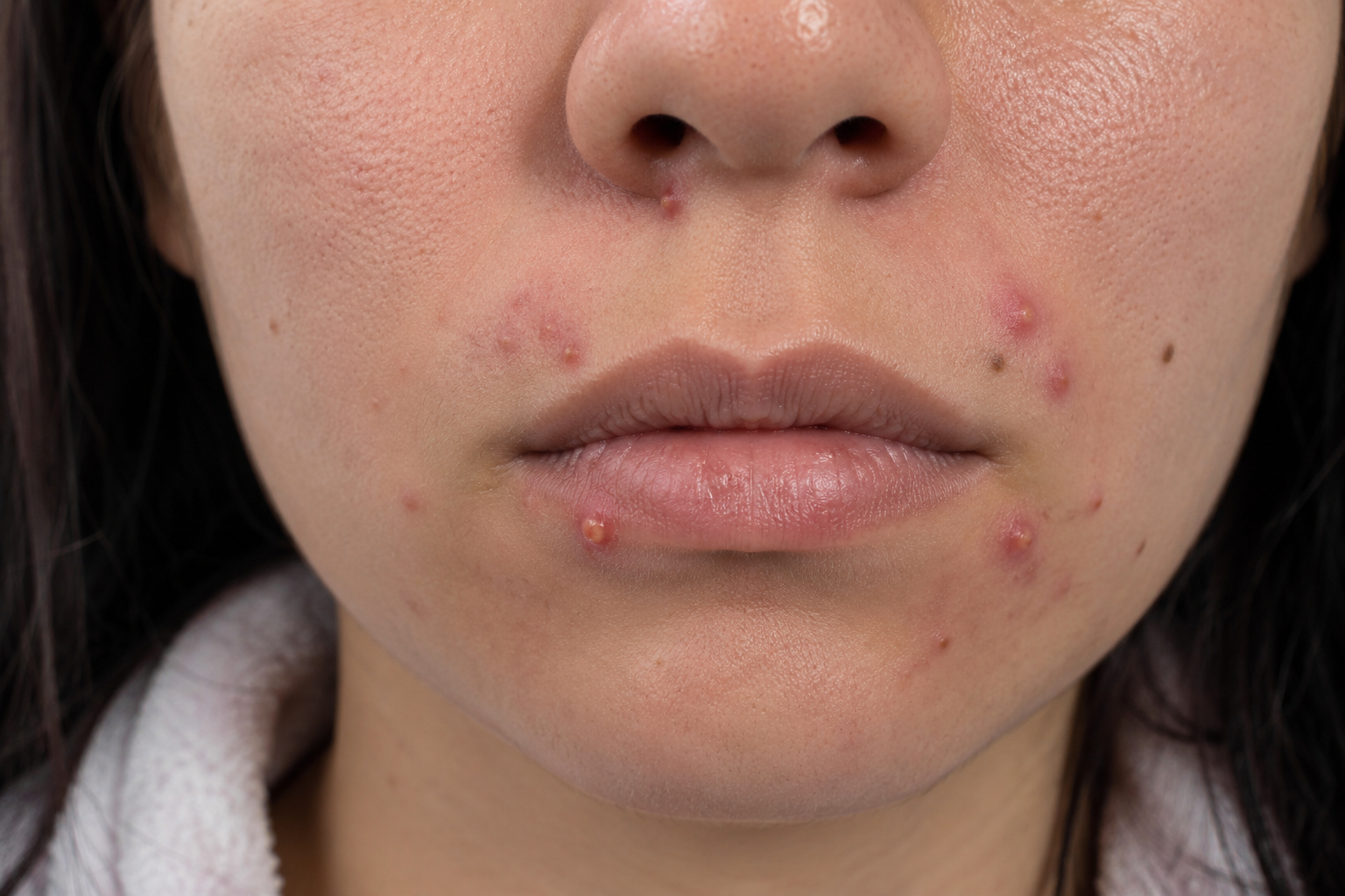 “Why Am I Still Getting Painful Lip Acne at 38 — and What Treatments Are Safe If I Want to Get Pregnant Soon?”