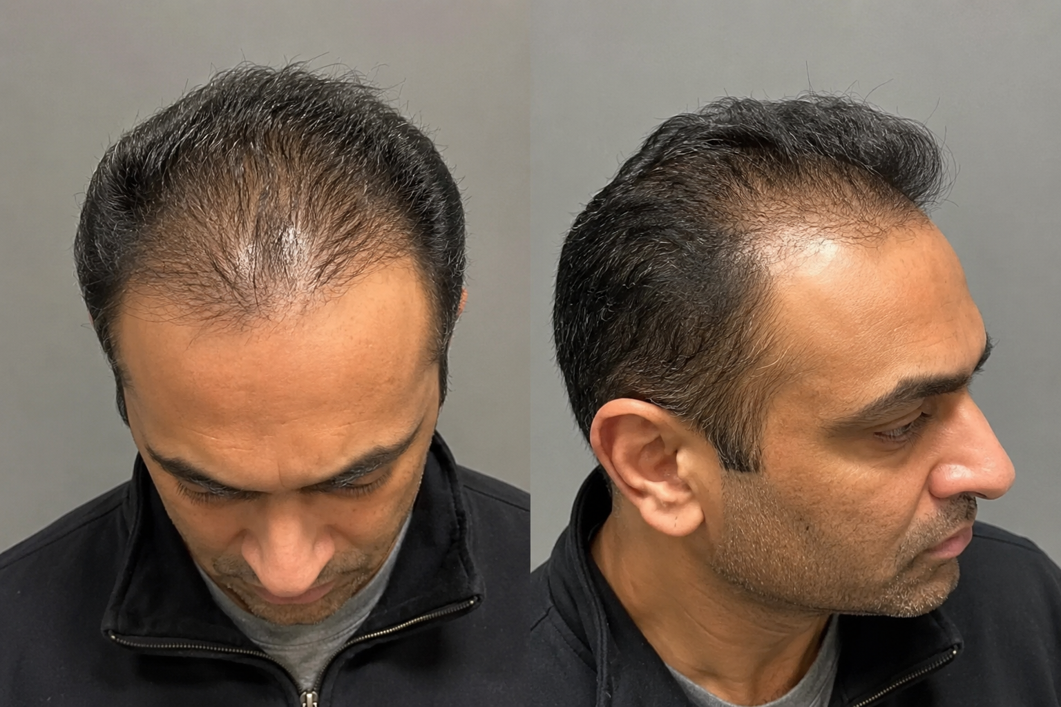 Frontal Fibrosing Alopecia vs. Male Pattern Hair Loss: Why Getting the Right Diagnosis Matters