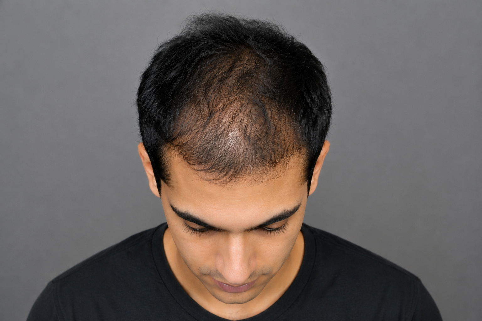 25-Year-Old Man Achieves Early Hair Loss Stabilization with Oral Minoxidil and Dutasteride