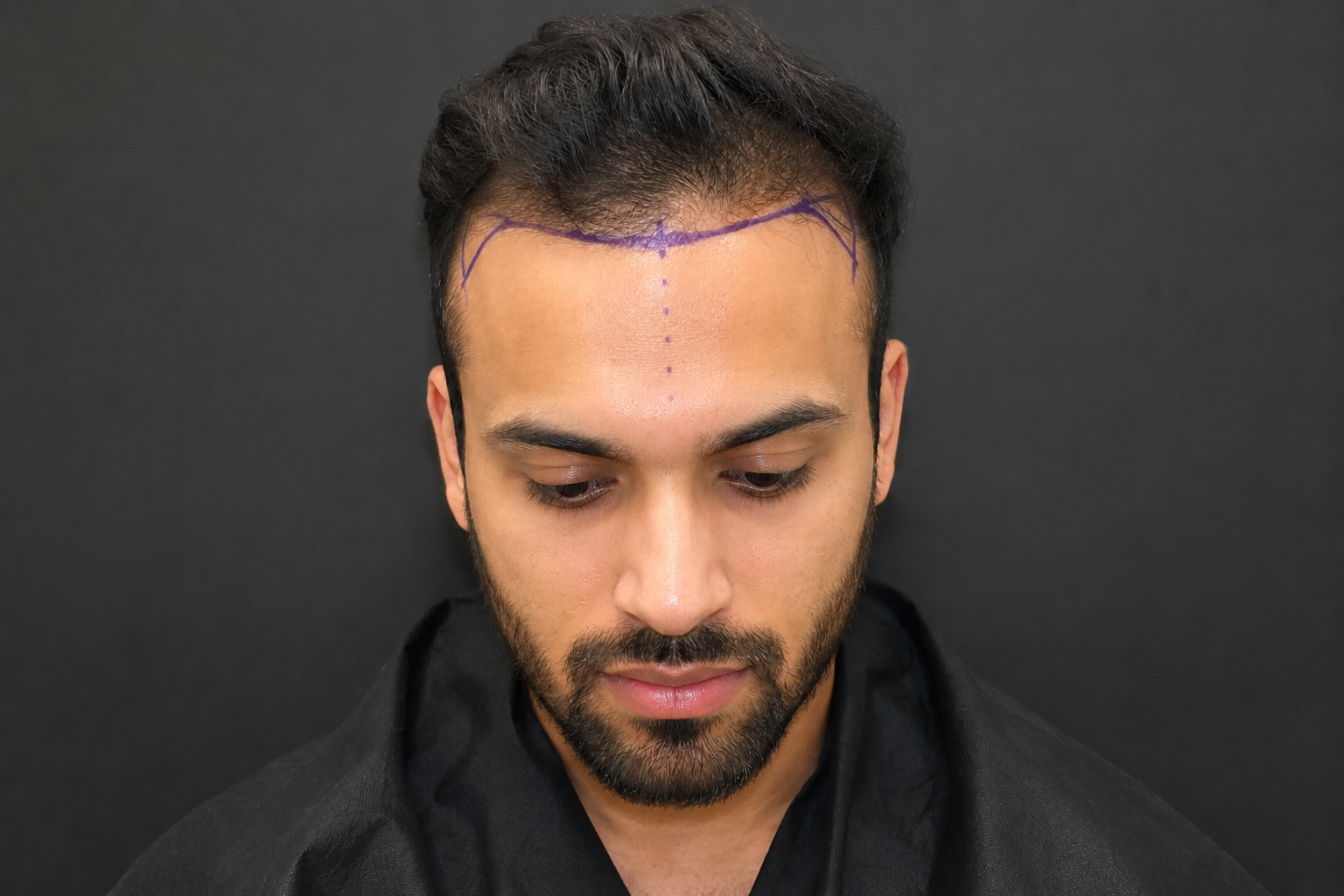 "I'm 25 and notice my hair is thinning. Can oral minoxidil and PRP therapy actually grow my hair back?"&nbsp;