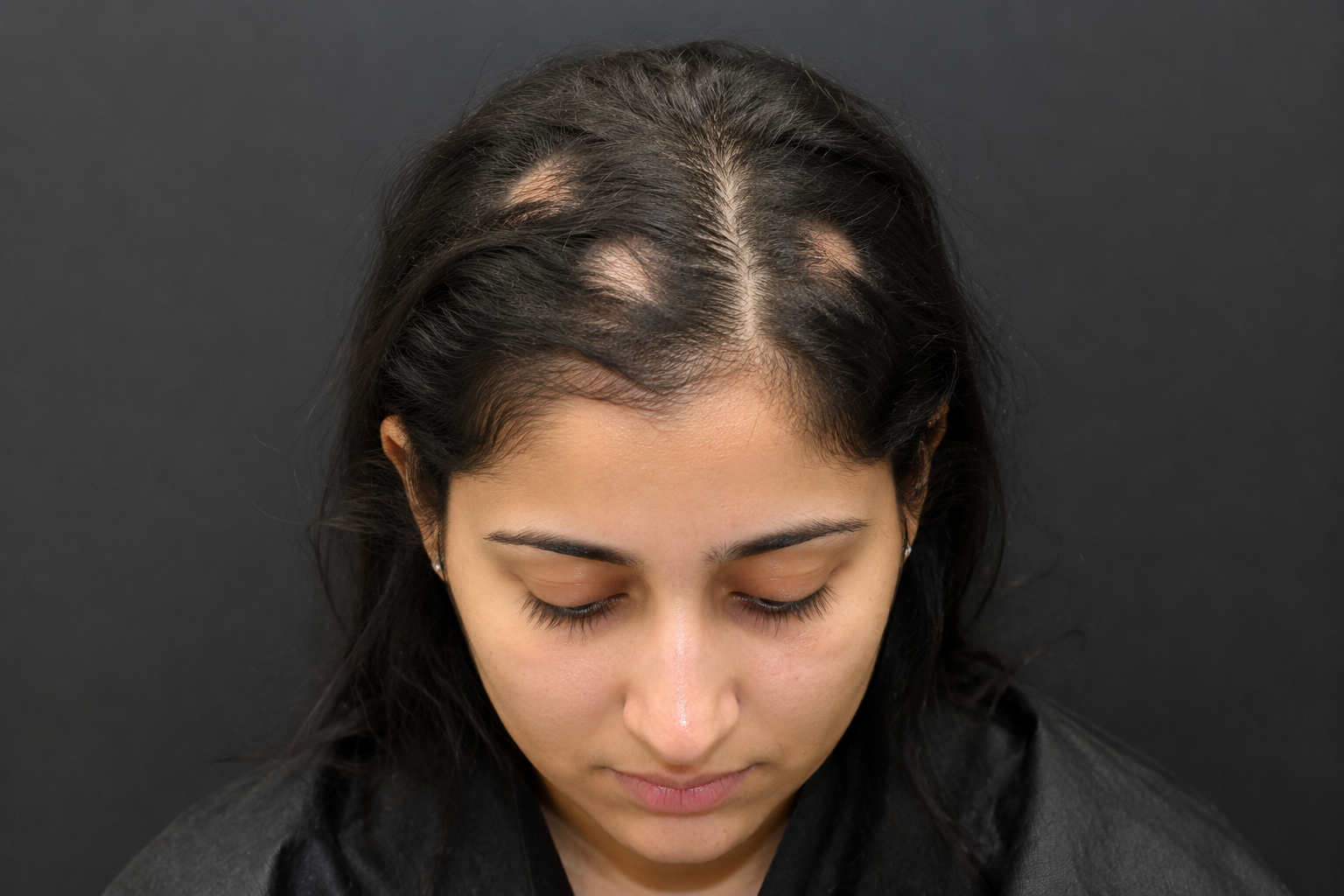 "I’m a 25-year-old woman with patchy hair loss that keeps spreading. Can steroid injections finally fix it?"&nbsp;