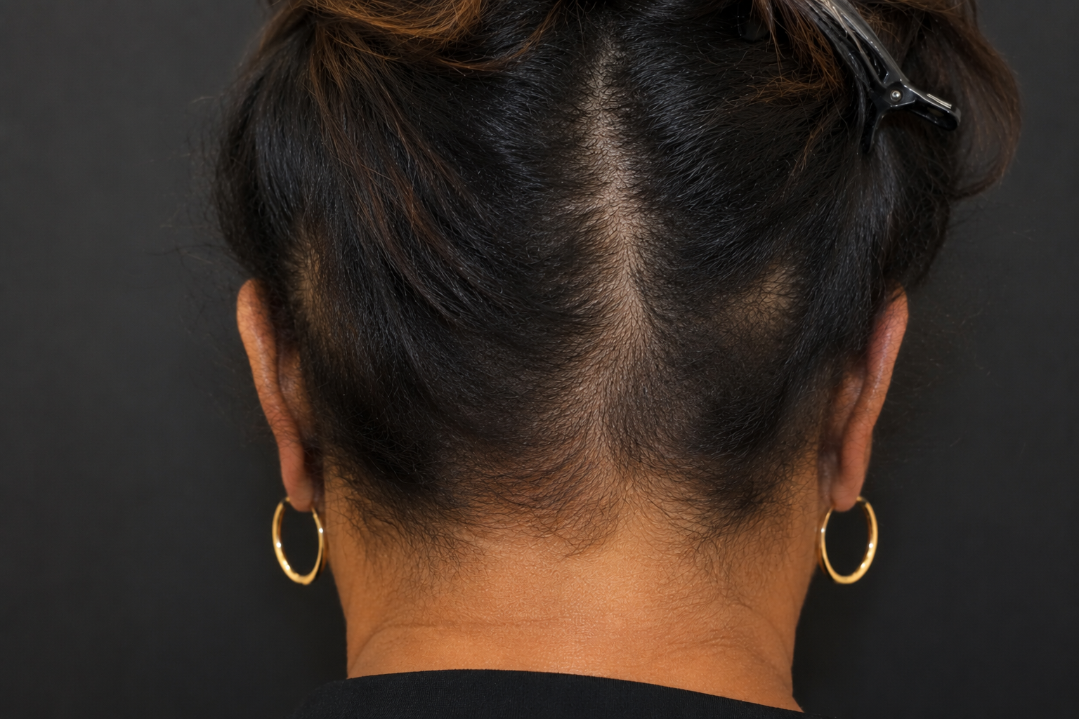“Why Am I Losing Hair in Random Patches? A Houston Dermatologist Answers My Fears “
