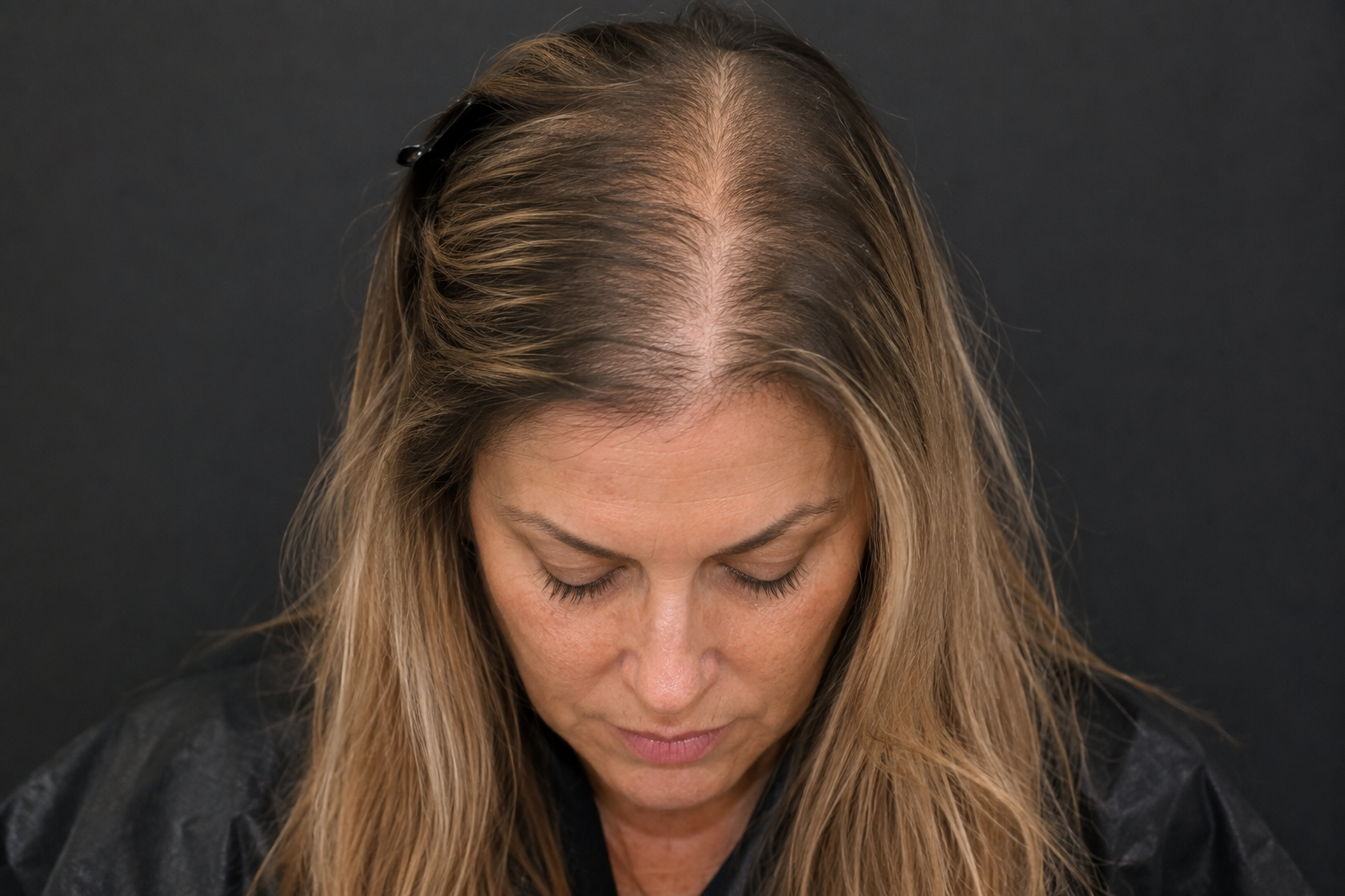 “Why Is My Hair Thinning After Weight Loss Peptides and Hormone Pellets? “