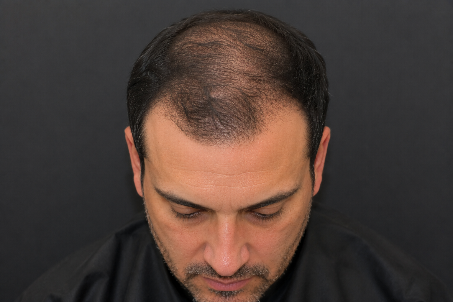 "I Don't Want to Take Hair Loss Pills. Can PRP Injections and Topical Foam Actually Regrow My Hair?"