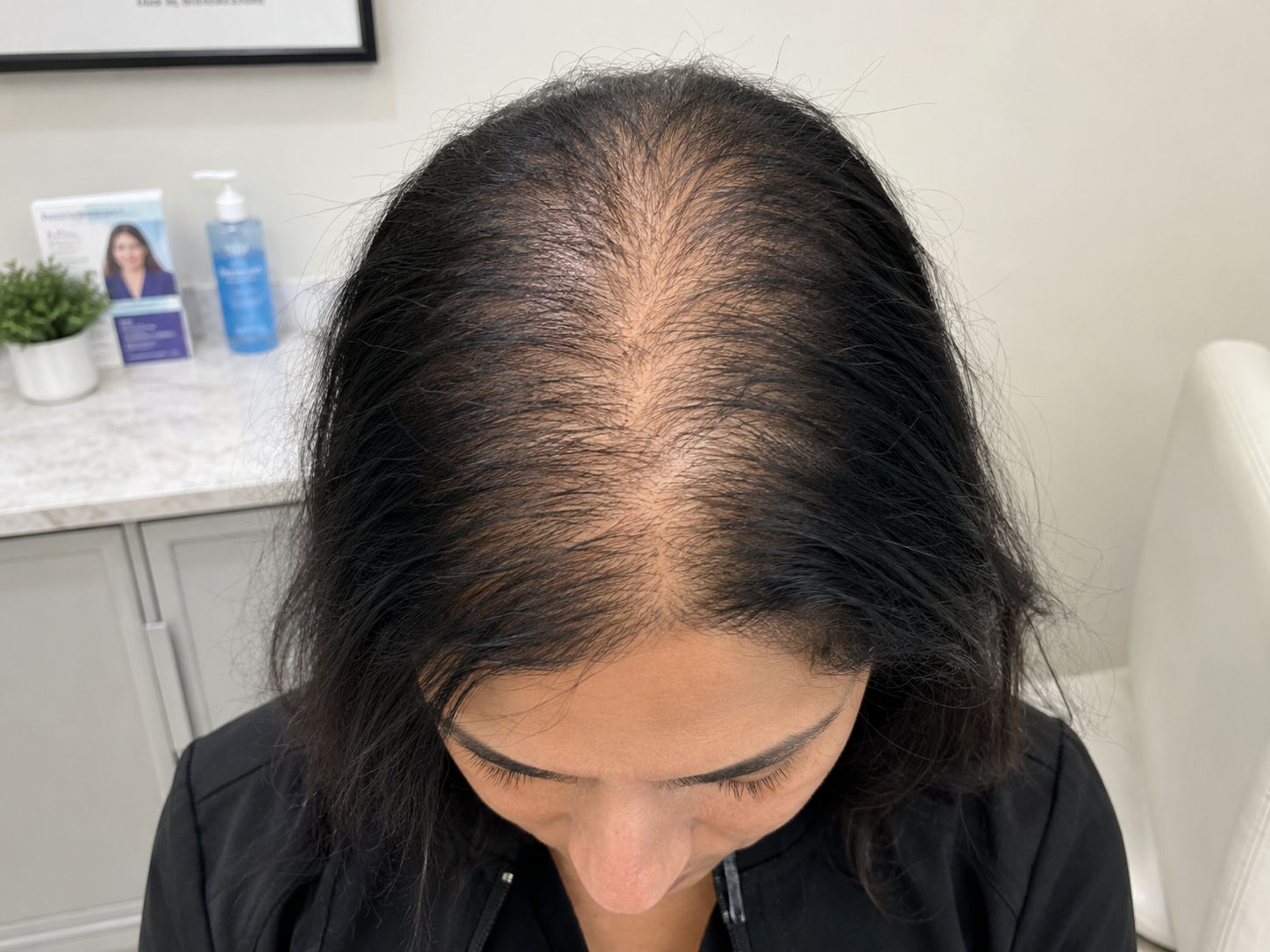 "I've Been Taking Minoxidil for Over a Year, So Why Is My Hair Still Falling Out?" A Houston Hair Loss Specialist Explains