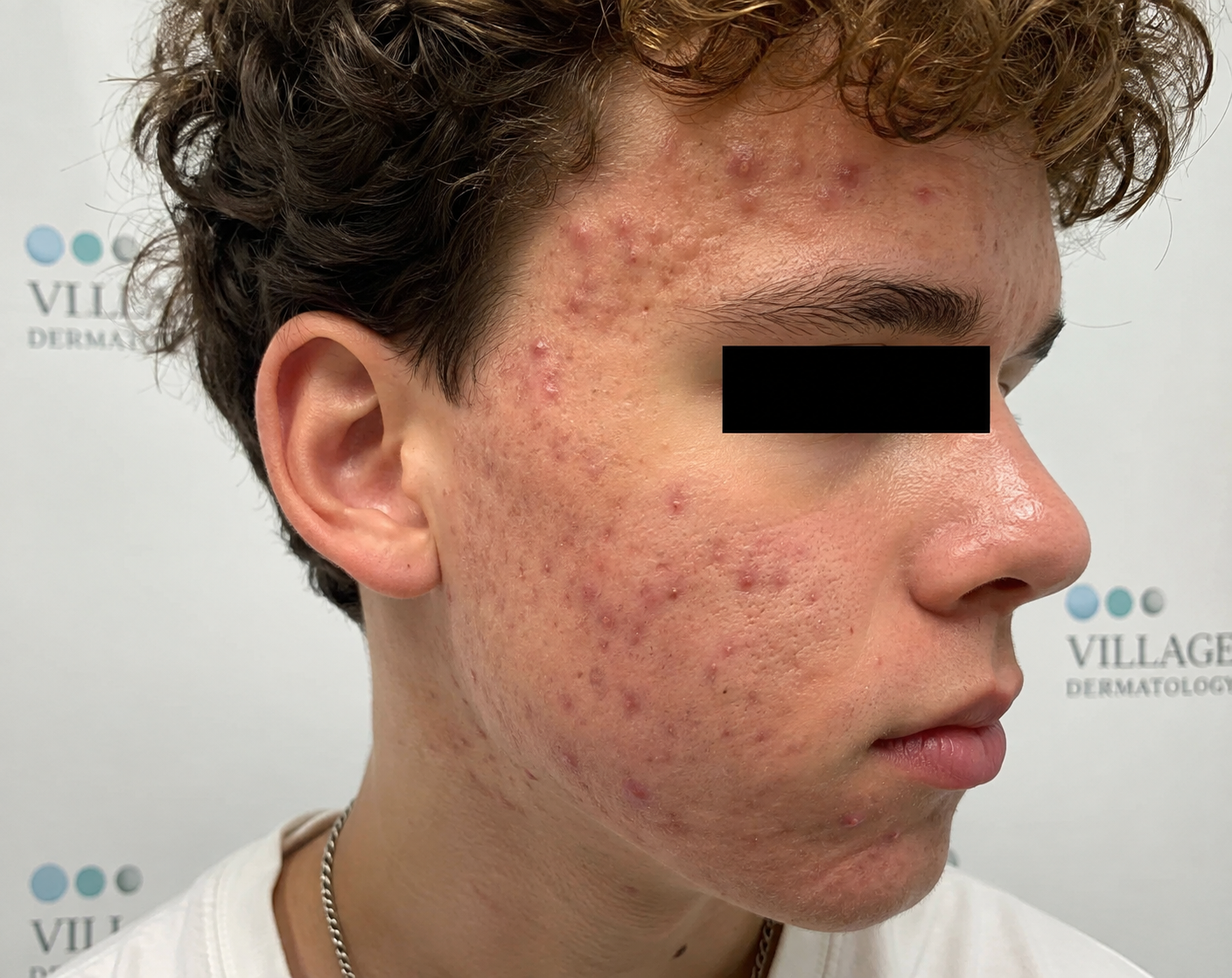 What Should Families Know When Topicals Fail, and How Can a Dermatologist in Houston or Katy Stop Cystic Acne Scars?