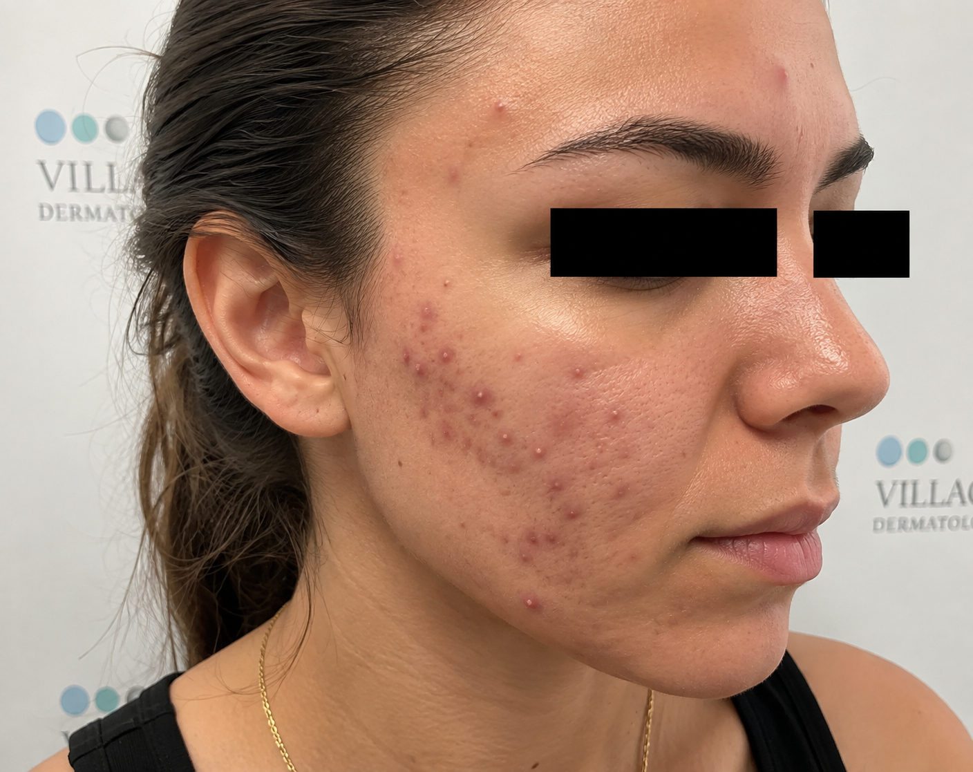 What Happens When Your Isotretinoin Dose Increases, and How Can a Dermatologist in Houston or Katy Help?