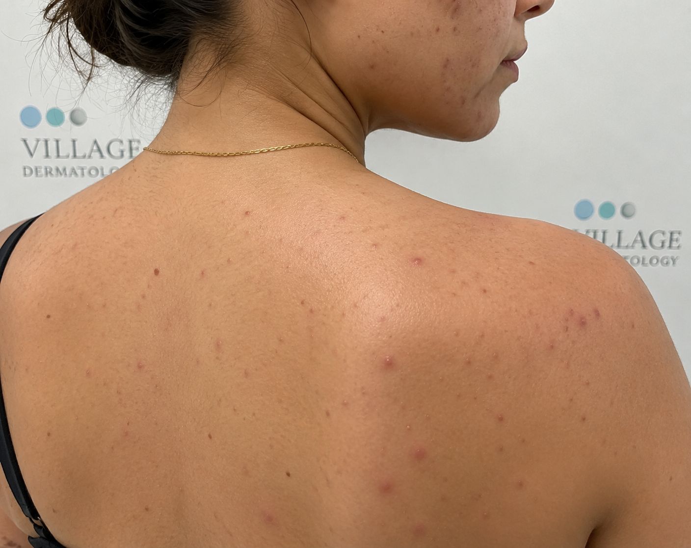 How Can You Treat Adult Acne While Successfully Managing Chronic Psoriasis?