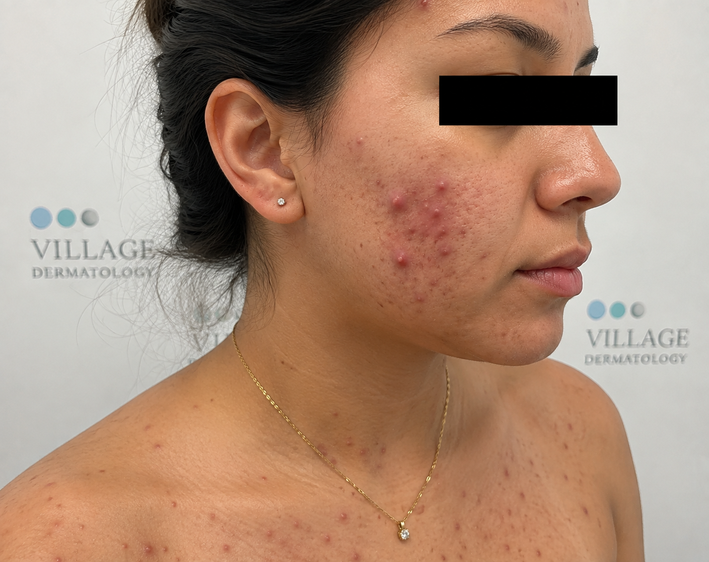 How Can You Treat Moderate Cystic Acne with Prescription Topicals, and Can a Dermatologist in Houston or Katy Help?