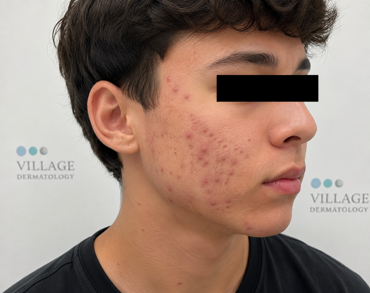 When Topical Acne Treatments Fail, How Can a Dermatologist in Houston or Katy Help Clear Severe Breakouts?