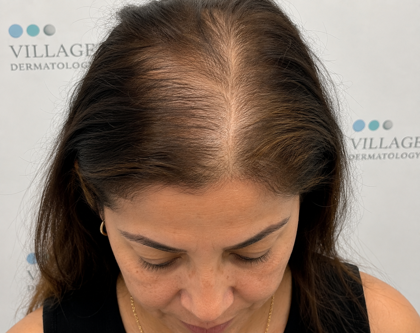 How Can a Combination of Oral Minoxidil and PRP Hair Injections Reverse Female Pattern Hair Loss?