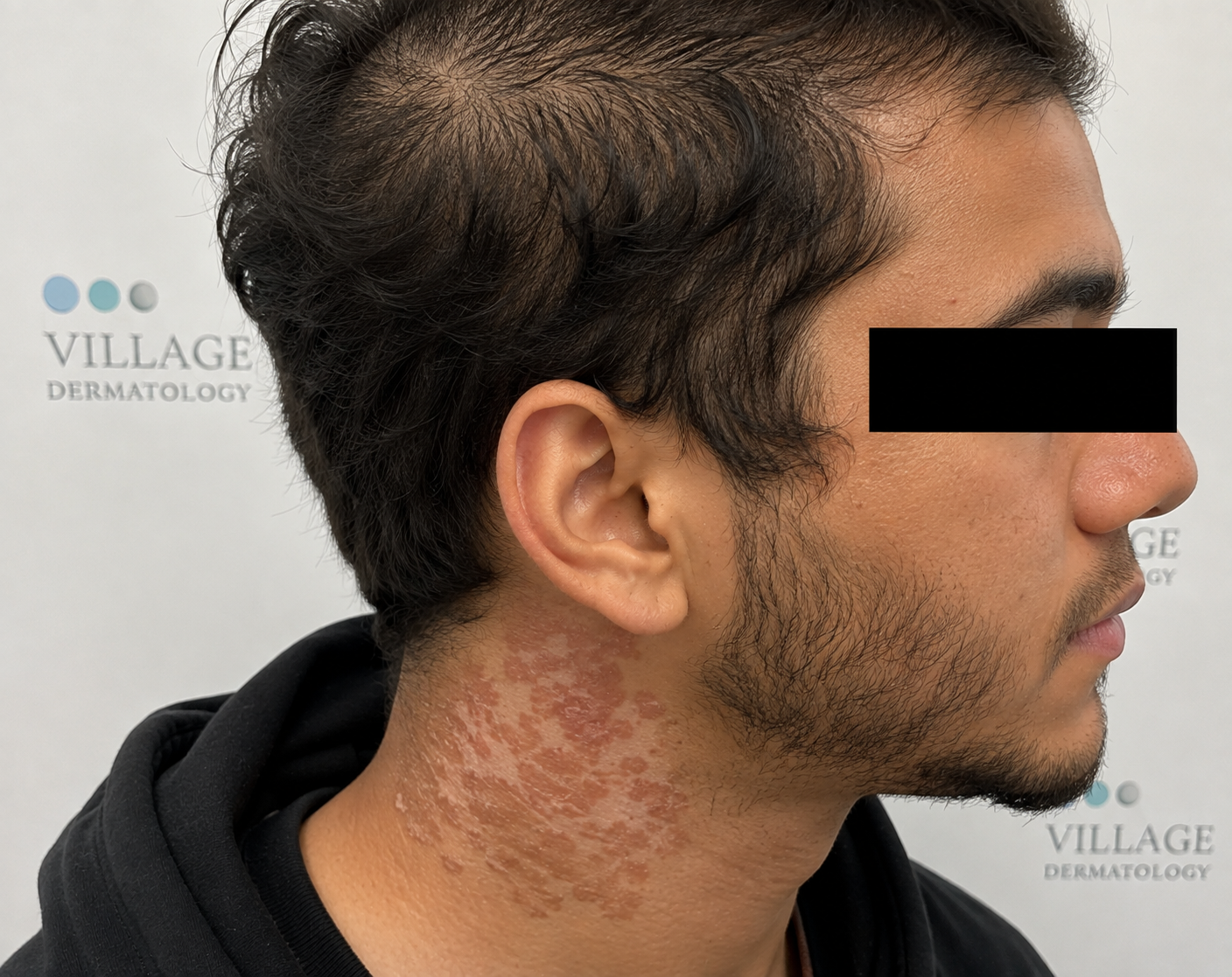 How Can a Houston Dermatologist Treat Diffuse Hair Loss and Sweating-Induced Neck Rashes?