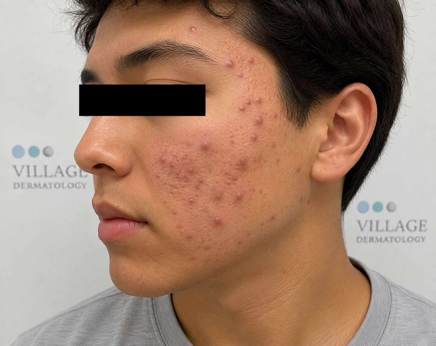 How Can a Houston Dermatologist Transition Patients from Failed Topicals to Isotretinoin for Severe Acne?