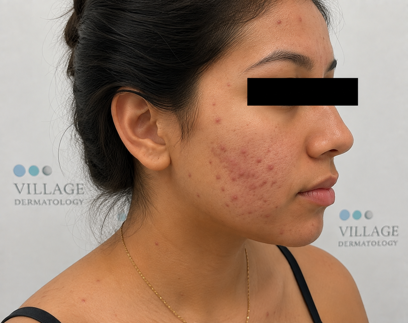 How Can Topical Retinoids and Clindamycin-Benzoyl Peroxide Treat Persistent Facial and Body Acne?