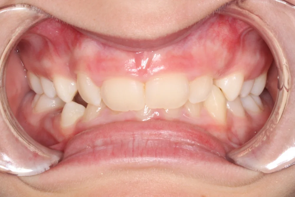 Orthodontic Results | Northern Beaches Orthodontists - Dee Why & Mona Vale