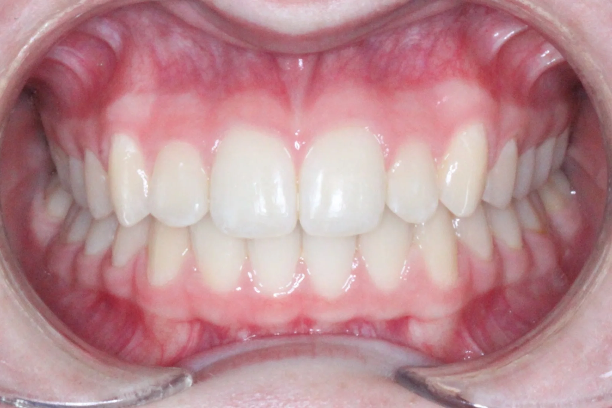 Orthodontic Results | Northern Beaches Orthodontists - Dee Why & Mona Vale