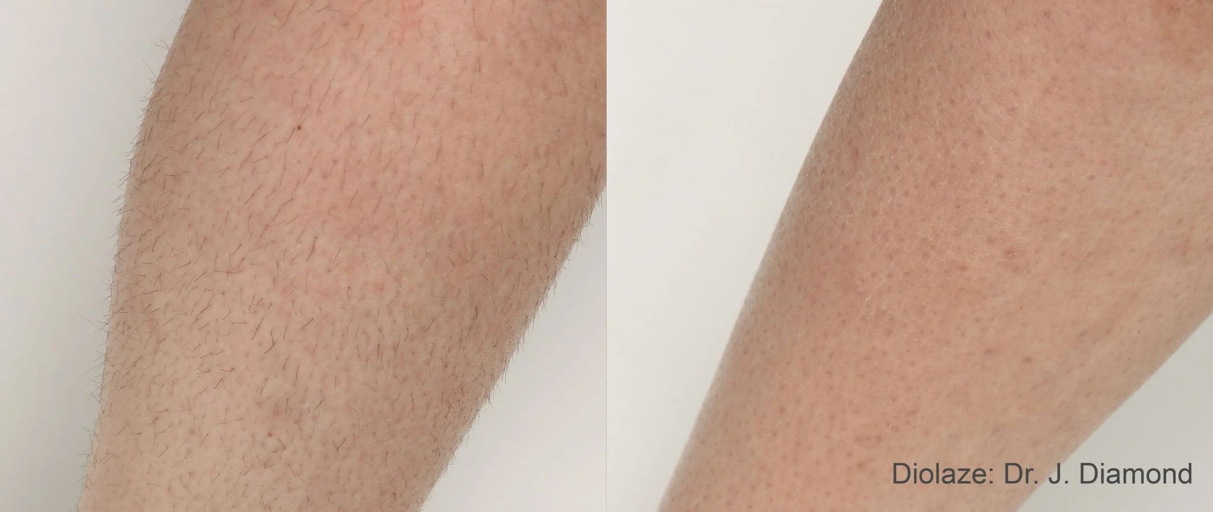 diolazexl-before-after-dr-j-diamond-preview-1.jpg