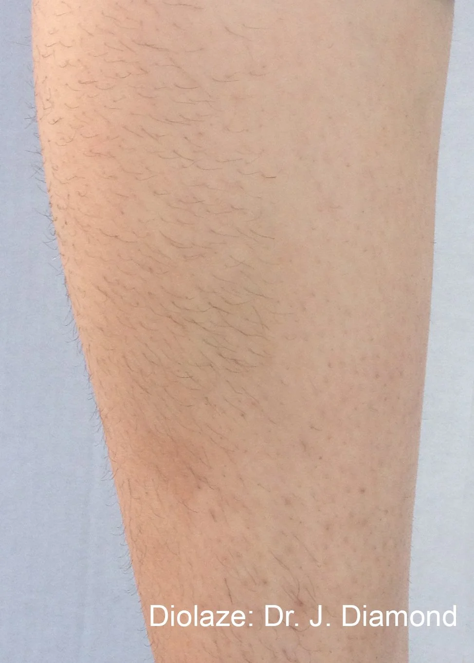 diolazexl-before-after-dr-j-diamond-preview-2.jpg