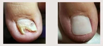 LCN Toe Nail Reconstruction In Frodsham Chester And Cheshire Novum LCN Toe Nail Reconstruction In Frodsham Chester And Cheshire Novum