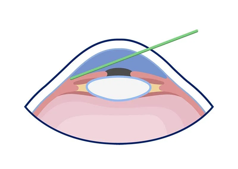 Selective Laser Trabeculoplasty — Dublin Eye Surgeon Pavi Agrawal