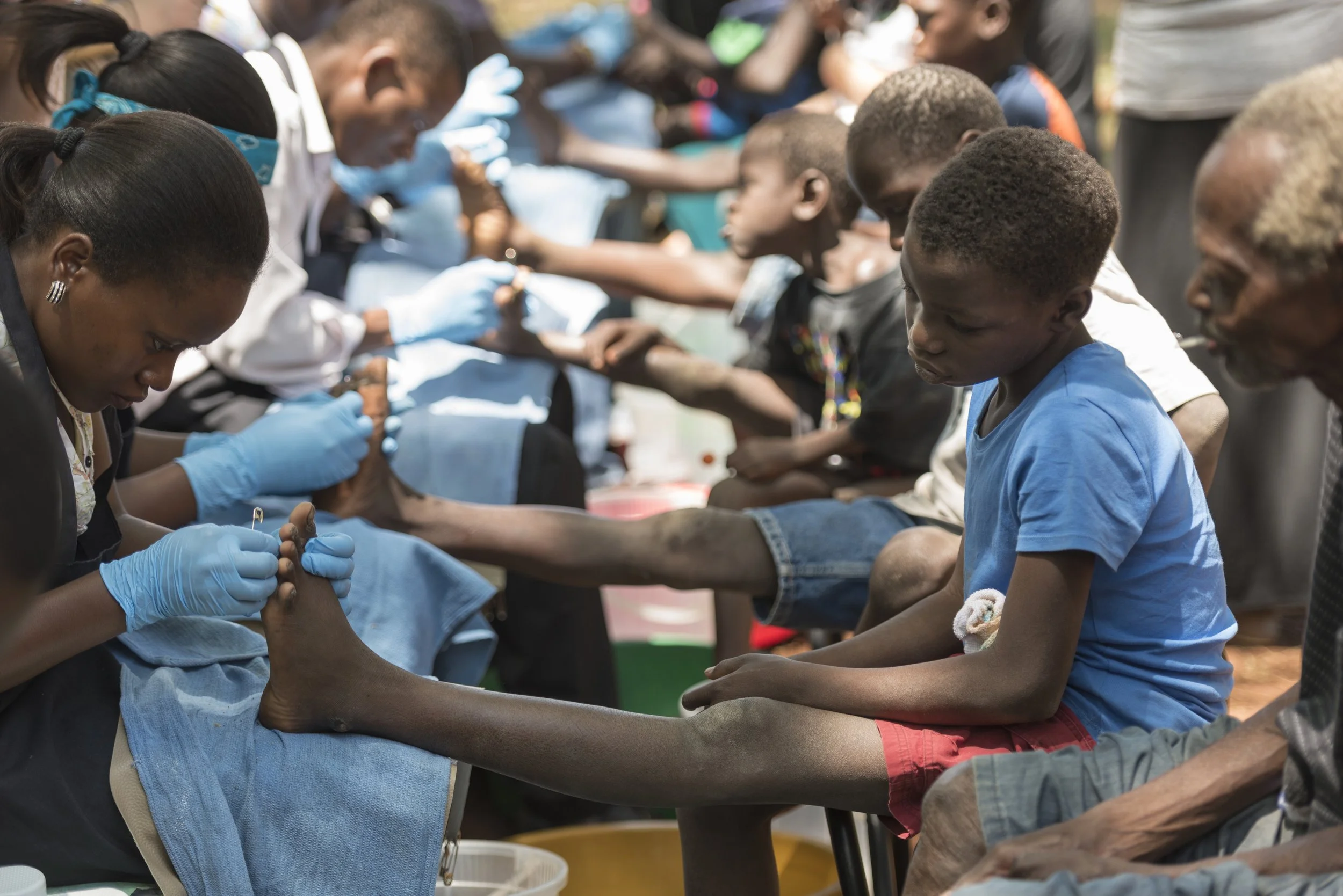 Eradicating Jiggers Transforming Lives Through Education and Treatment