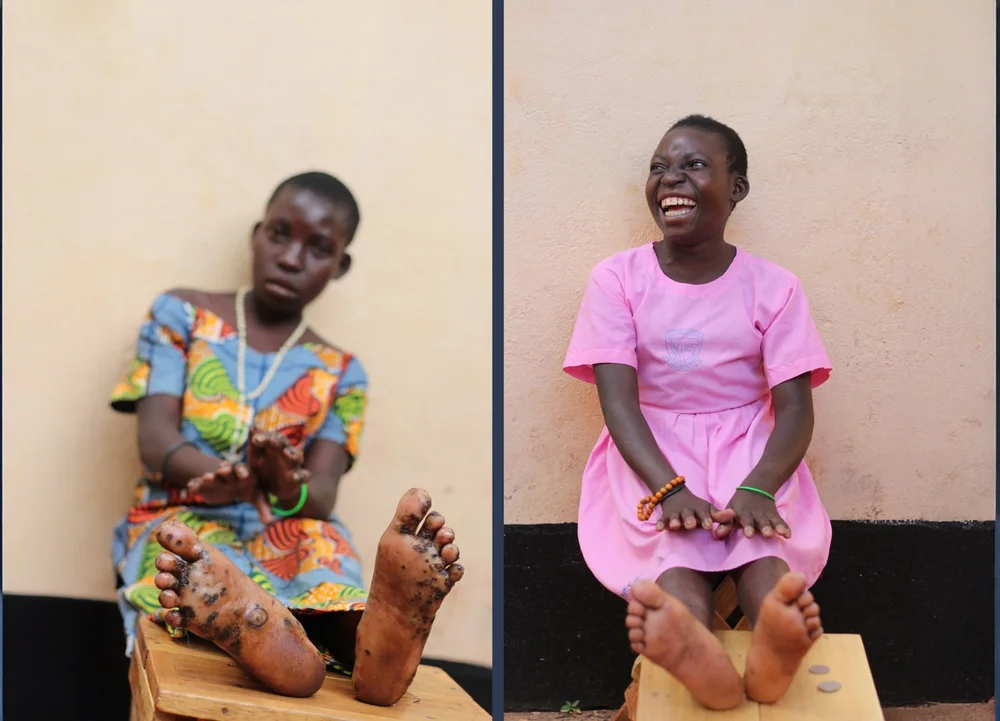 Joy before and after jigger treatment at Sole Hope