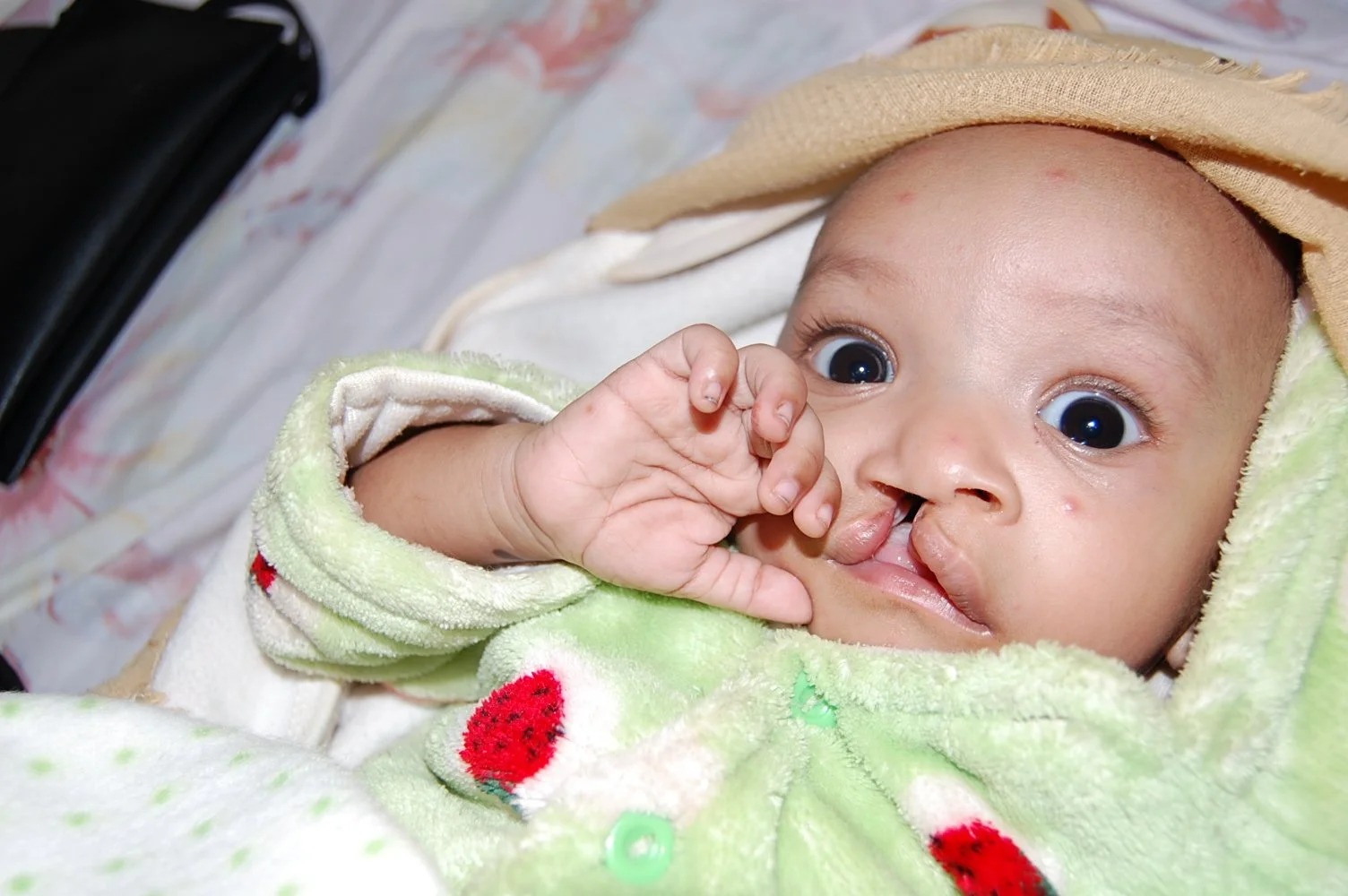 Mahir before receiving nutritional support in August 2024