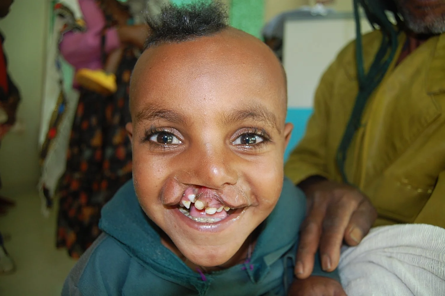 March-2026-Gamby-Hospital-Yeayesaw-Misganu-Before-4month.JPG