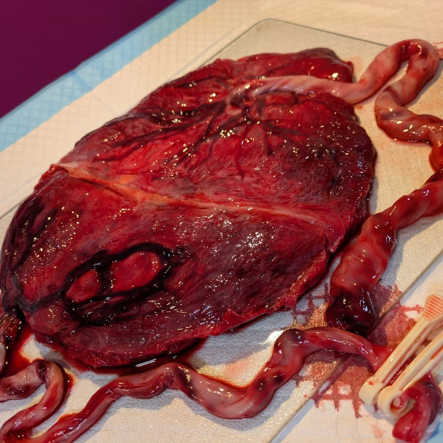 OMG you guys, this placenta is/these placetas are so cool!
 
So this is from a twin pregnancy where there were actually TWO separate placentas that fused together during development.

One baby had the textbook-perfect central cord insertion (right in