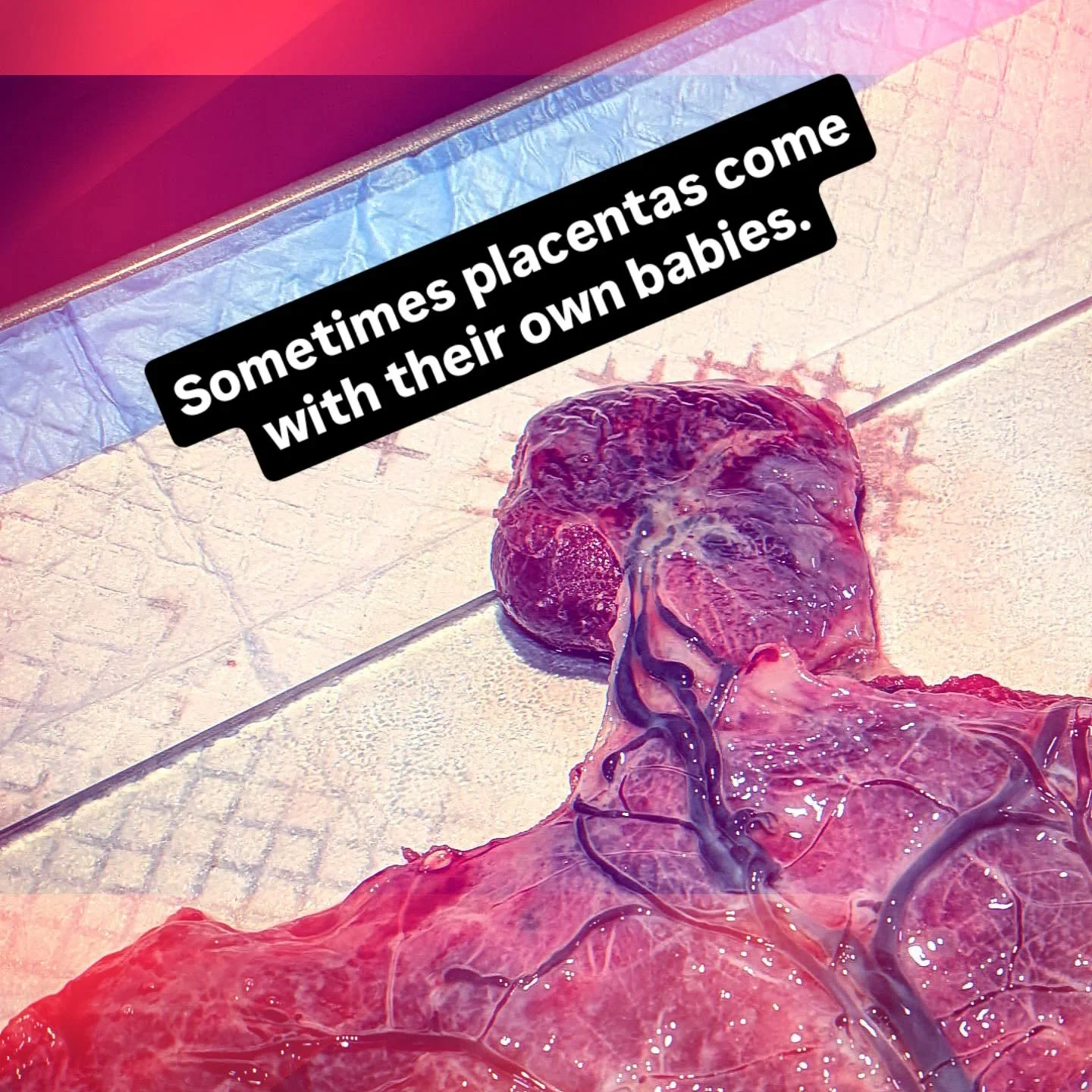 Something I enjoy about placentas is that there are so many anomalies. 

Anomaly: deviation from the common rule

This placenta has a little buddy... It's called a succenturiate lobe. It's a smaller accessory lobe that's connected to the main placent