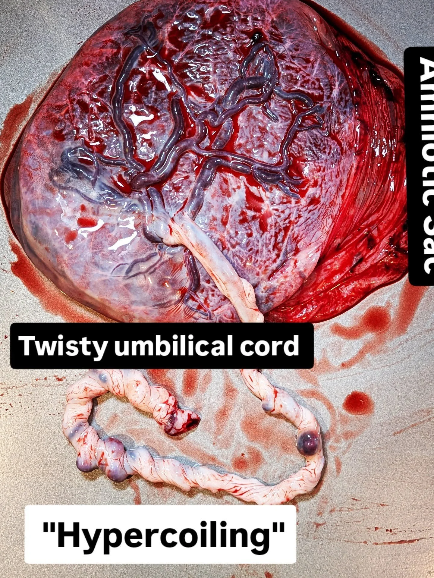 Placentas are so cool. It's such a bummer that so many of them get trashed.

#placentaencapsulation #njplacenta #placentapills #umbilicalcord #southjerseydoula