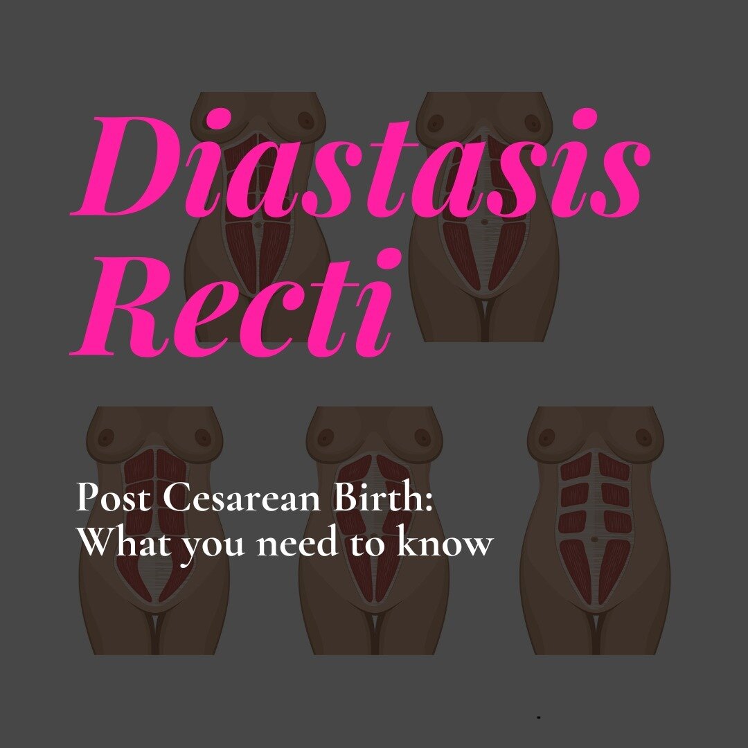 Rehabilitating diastasis recti (DR) in cesarean birth moms takes a unique path. Why? 

Our bodies undergo remarkable changes in pregnancy, and the abdominal muscles play a pivotal role. However, for a cesarean mom, these muscles have not only been st